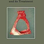 خرید و دانلود نسخه کامل کتاب A Treatise on Otoslerosis and its Treatment