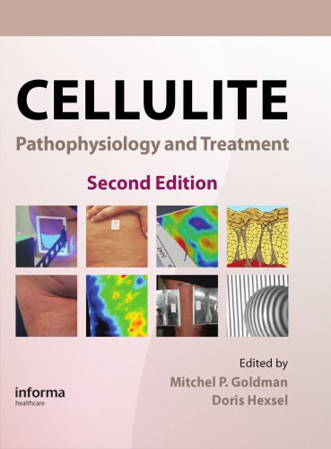 خرید و دانلود نسخه کامل کتاب Cellulite: Pathophysiology and Treatment, 2nd Edition (Basic and Clinical Dermatology)_68b3696048d09.jpeg خرید و دانلود نسخه کامل کتاب Cellulite: Pathophysiology and Treatment, 2nd Edition (Basic and Clinical Dermatology)