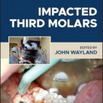 خرید و دانلود نسخه کامل کتاب Impacted Third Molars - Orginal Pdf