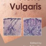 خرید و دانلود نسخه کامل کتاب Acne Vulgaris – Original PDF