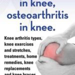 خرید و دانلود نسخه کامل کتاب Arthritis in knee, osteoarthritis in knee. Knee arthritis exercises and stretches, treatments, home remedies, knee replacements and knee braces all covered.