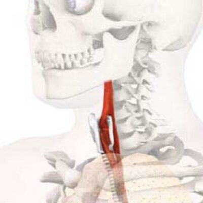 خرید و دانلود نسخه کامل کتاب Cancer of the Larynx: Current Concepts in the Treatment of the Neck (ORL)