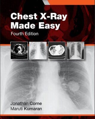 خرید و دانلود نسخه کامل کتاب Chest X-Ray Made Easy, 4th Edition (TRUE PDF)