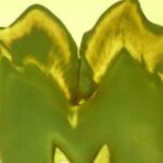 خرید و دانلود نسخه کامل کتاب Classes of Dental Caries