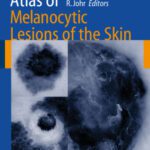 خرید و دانلود نسخه کامل کتاب Color Atlas of Melanocytic Lesions of the Skin
