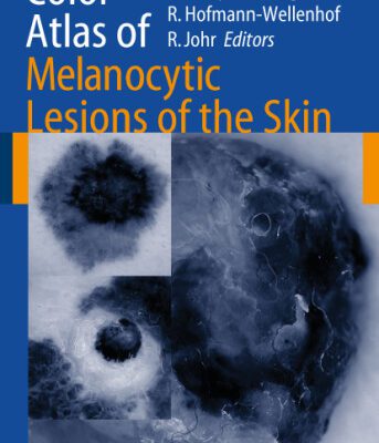 خرید و دانلود نسخه کامل کتاب Color Atlas of Melanocytic Lesions of the Skin