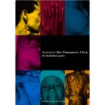 خرید و دانلود نسخه کامل کتاب Common Skin Diseases in Africa : an Illustrated Guide