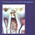 خرید و دانلود نسخه کامل کتاب Dental Caries: The Disease and Its Clinical Management