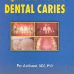 خرید و دانلود نسخه کامل کتاب Diagnosis and Risk Prediction of Dental Caries, Volume 2