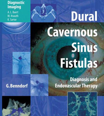 خرید و دانلود نسخه کامل کتاب Dural Cavernous Sinus Fistulas: Diagnosis and Endovascular Therapy (Medical Radiology   Diagnostic Imaging)