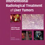 خرید و دانلود نسخه کامل کتاب Interventional Radiological Treatment of Liver Tumors (Contemporary Issues in Cancer Imaging)