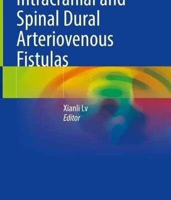 خرید و دانلود نسخه کامل کتاب Intracranial and Spinal Dural Arteriovenous Fistulas
