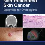 خرید و دانلود نسخه کامل کتاب Non-melanoma Skin Cancer: Essentials for Oncologists