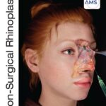 خرید و دانلود نسخه کامل کتاب Non-Surgical Rhinoplasty, Riccardo Nocini, Ali Pirayesh