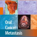 خرید و دانلود نسخه کامل کتاب Oral Cancer Metastasis