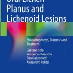 خرید و دانلود نسخه کامل کتاب Oral Lichen Planus and Lichenoid Lesions: Etiopathogenesis, Diagnosis and Treatment