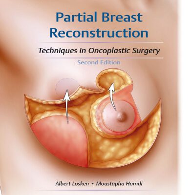 خرید و دانلود نسخه کامل کتاب Partial Breast Reconstruction: Techniques in Oncoplastic Surgery