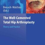 خرید و دانلود نسخه کامل کتاب The Well-cemented Total Hip Arthroplasty