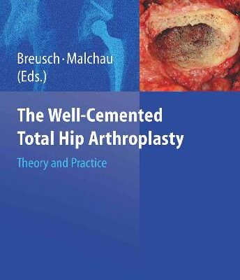 خرید و دانلود نسخه کامل کتاب The Well-cemented Total Hip Arthroplasty