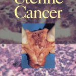 خرید و دانلود نسخه کامل کتاب Uterine Cancer