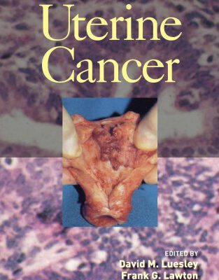 خرید و دانلود نسخه کامل کتاب Uterine Cancer
