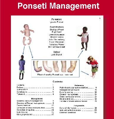 خرید و دانلود نسخه کامل کتاب Clubfoot Ponseti Management