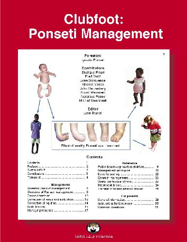 خرید و دانلود نسخه کامل کتاب Clubfoot Ponseti Management_68dd2d250da0f.jpeg خرید و دانلود نسخه کامل کتاب Clubfoot Ponseti Management